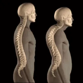 Illustration comparing a normal spine and a curved spine, side by side